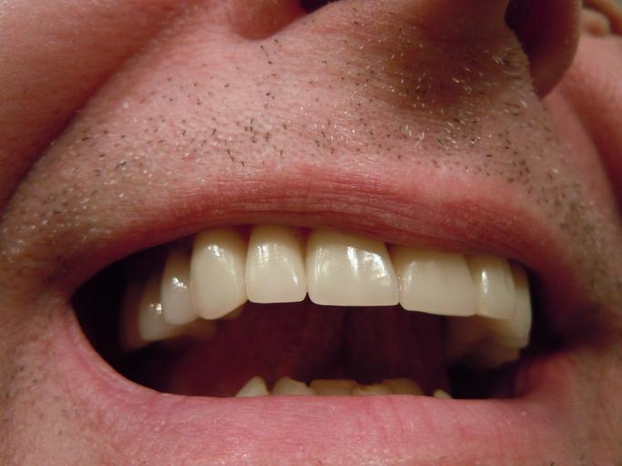 horní zuby
